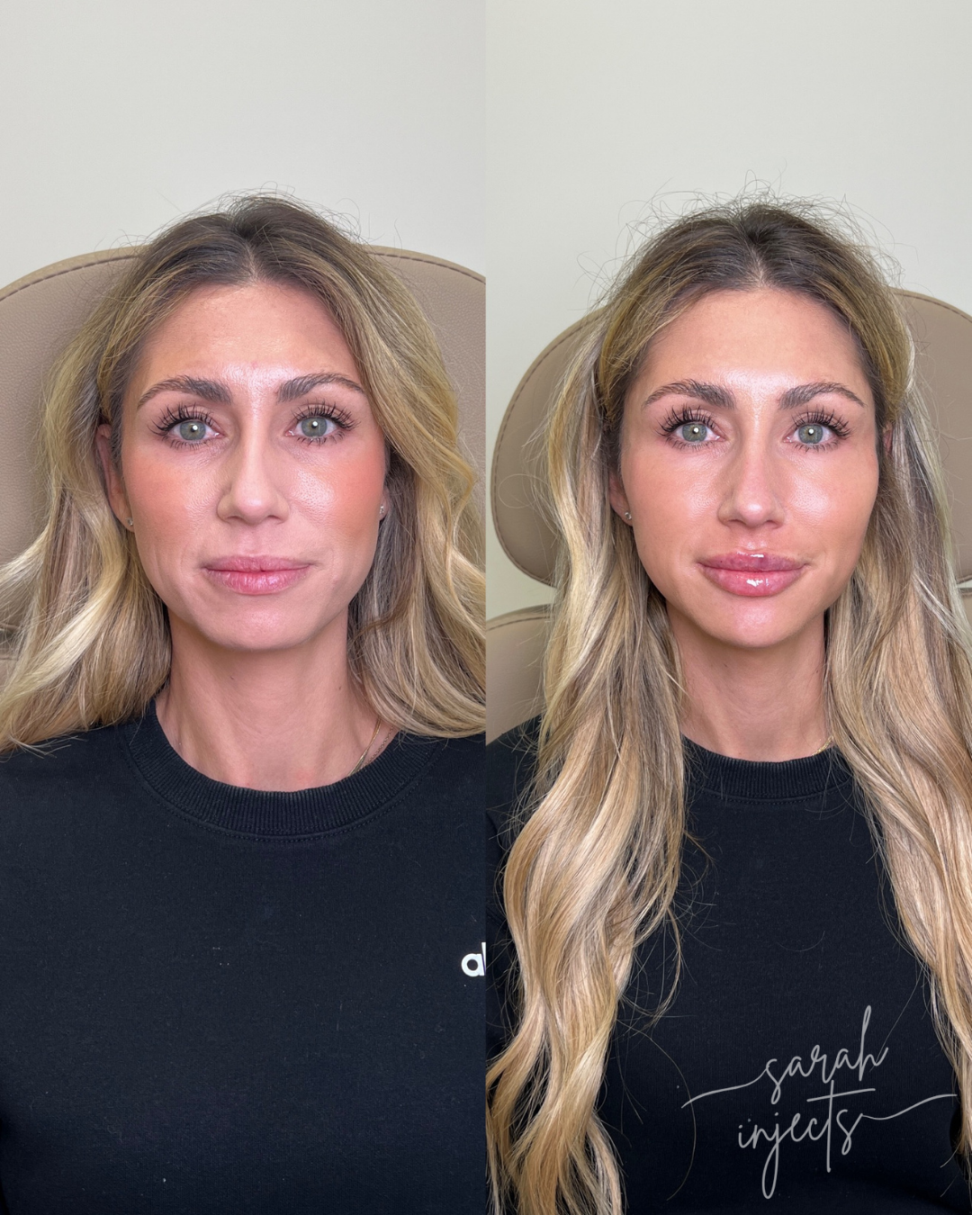 Lily Lift Before and After — Facial Balancing