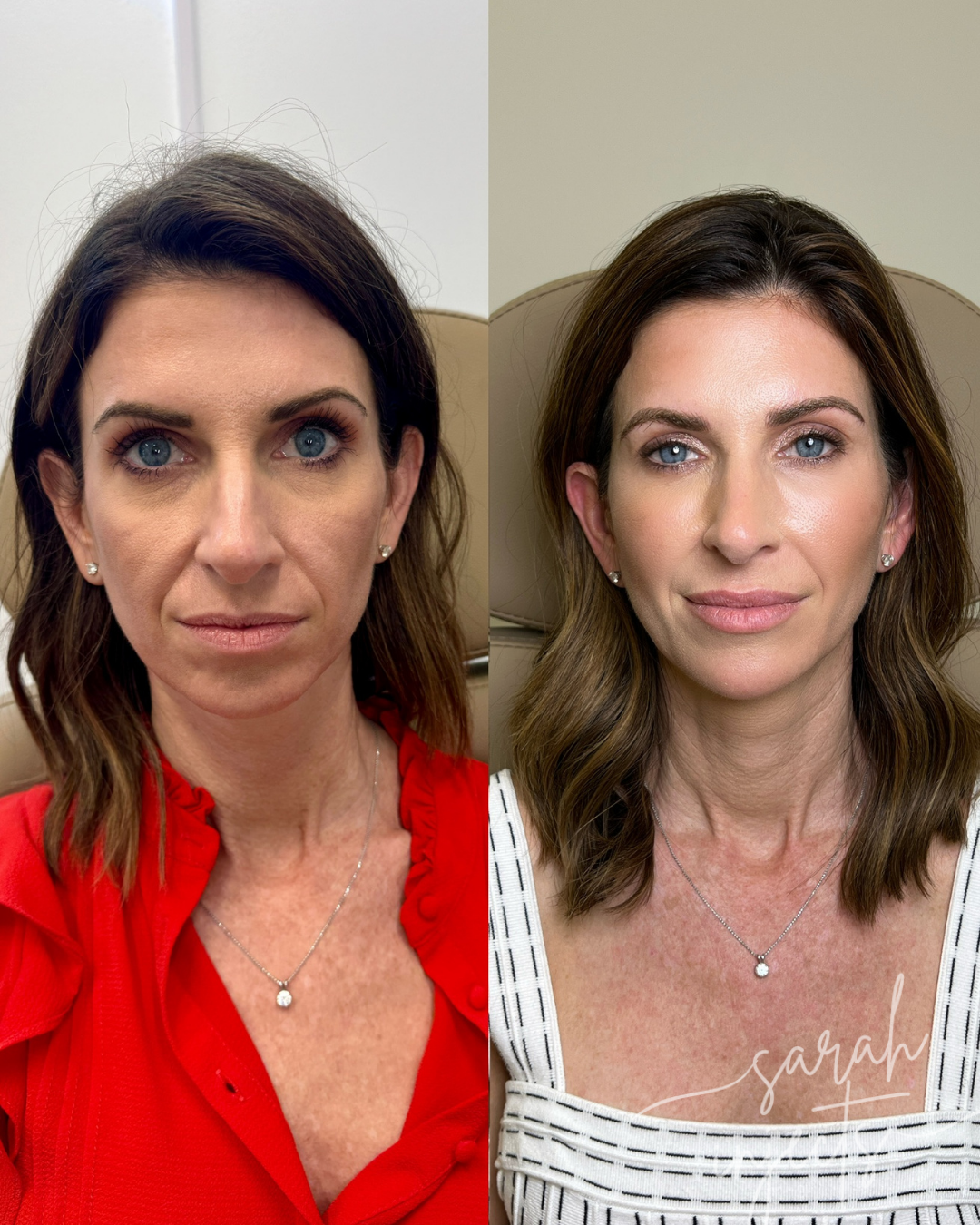 Lily Lift Before and After — Full Lily Lift