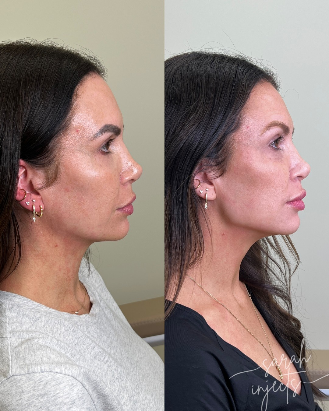 Lily Lift Before and After — Jawline Refinement