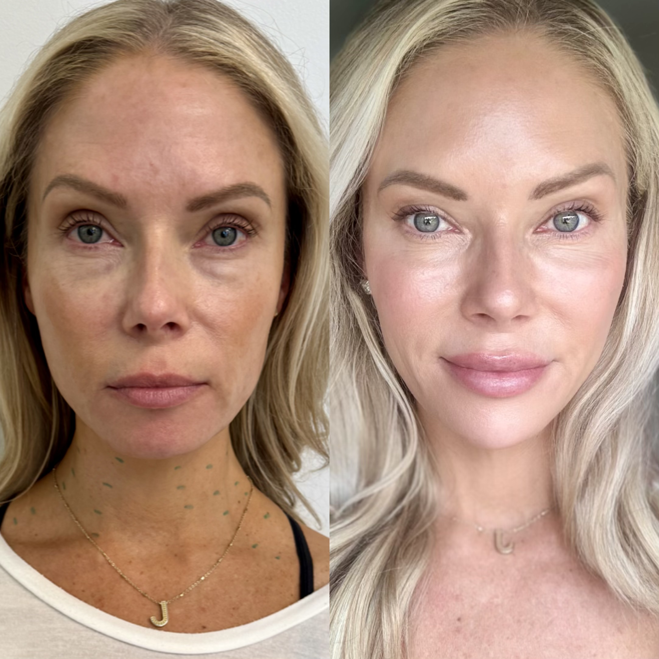 Lily Lift Before and After — Midface Volume