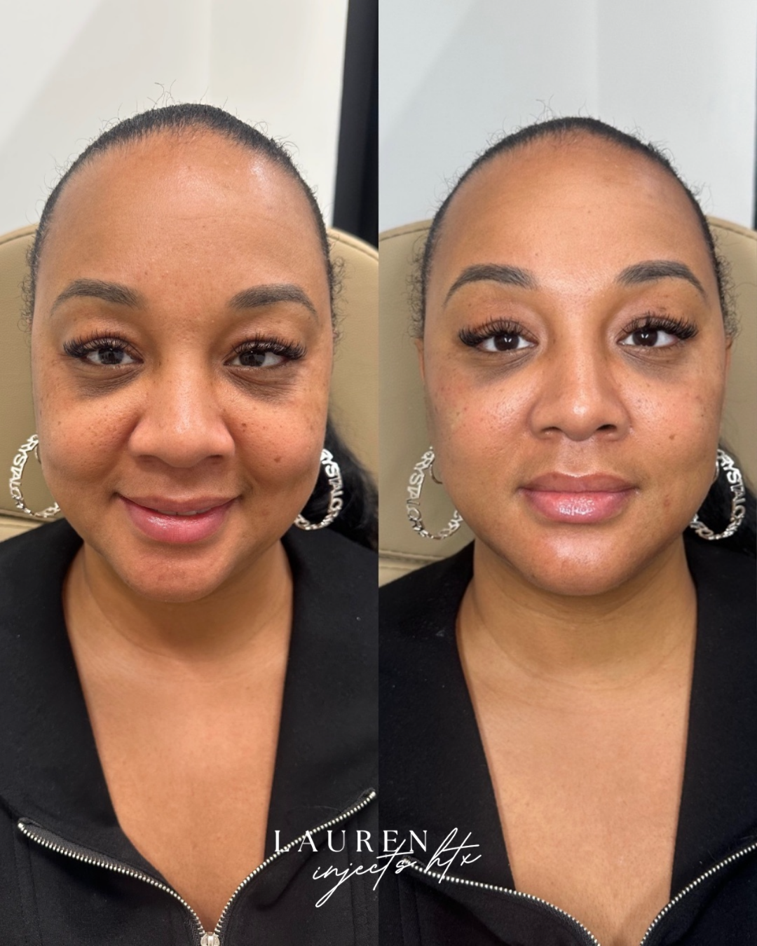 Lily Lift Before and After — Neurotoxin