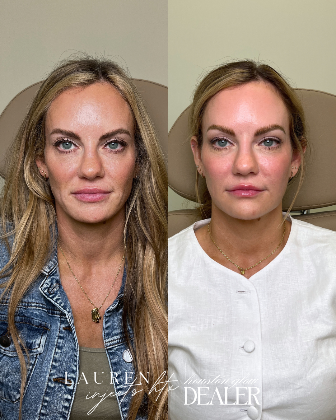 Lily Lift Before and After — Full Lily Lift